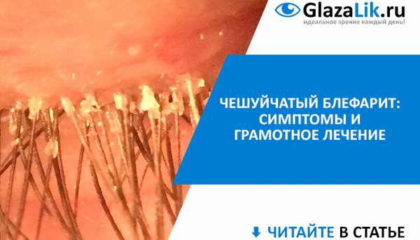 симптомы и лечение чешуйчатого блефарита